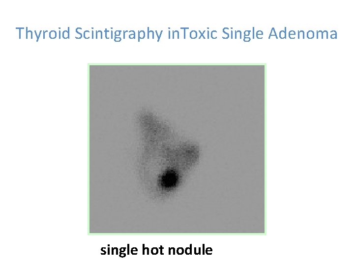 Thyroid Scintigraphy in. Toxic Single Adenoma single hot nodule 