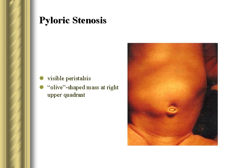 Pyloric Stenosis l visible peristalsis l “olive”-shaped mass at right upper quadrant 