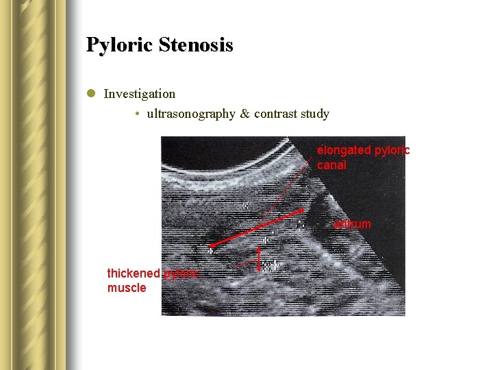 Pyloric Stenosis l Investigation • ultrasonography & contrast study elongated pyloric canal antrum thickened