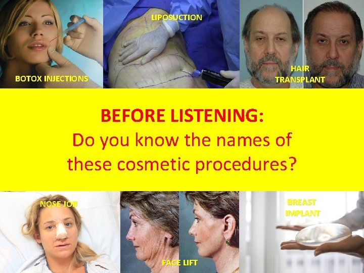 LIPOSUCTION HAIR TRANSPLANT BOTOX INJECTIONS BEFORE LISTENING: Do you know the names of these