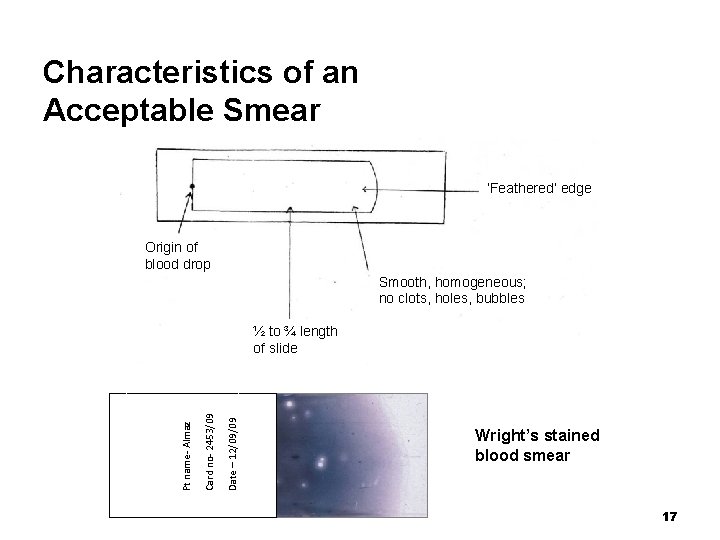 Characteristics of an Acceptable Smear ‘Feathered’ edge Origin of blood drop Smooth, homogeneous; no