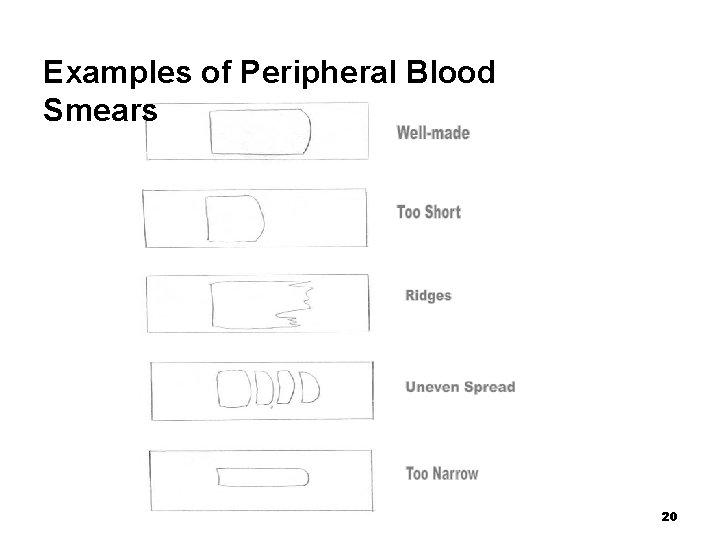 Examples of Peripheral Blood Smears 20 