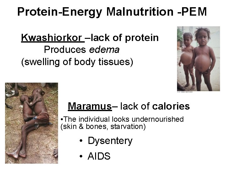 Protein-Energy Malnutrition -PEM Kwashiorkor –lack of protein Produces edema (swelling of body tissues) Maramus–
