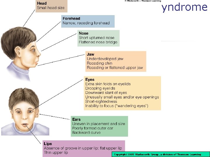 Fetal Alcohol Syndrome Copyright 2005 Wadsworth Group, a division of Thomson Learning 