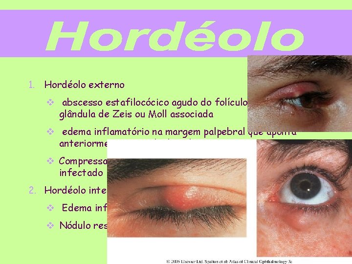 1. Hordéolo externo v abscesso estafilocócico agudo do folículo piloso e sua glândula de