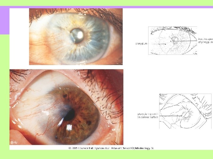 . v Crescimento fibrovascular subepitelial de um tecido conjuntival degenerativo que invade a córnea.