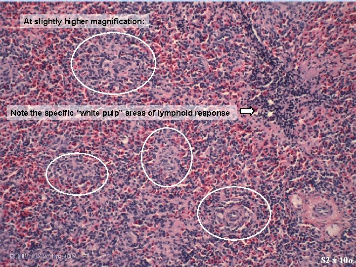 At slightly higher magnification: Note the specific “white pulp” areas of lymphoid response S