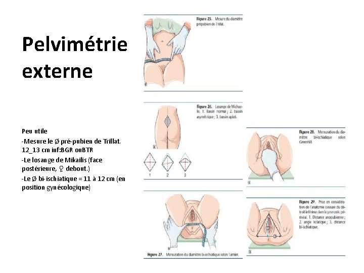 Pelvimétrie externe Peu utile -Mesure le Ø pré-pubien de Trillat. 12_13 cm inf: BGR