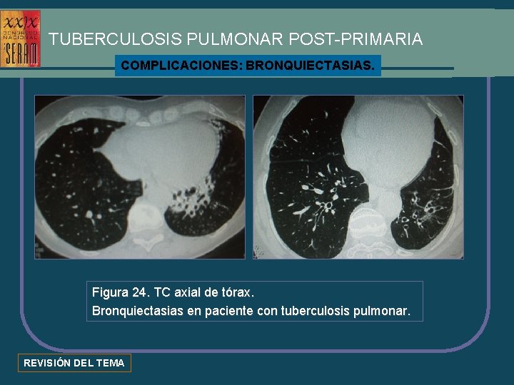 TUBERCULOSIS PULMONAR POST-PRIMARIA COMPLICACIONES: BRONQUIECTASIAS. Figura 24. TC axial de tórax. Bronquiectasias en paciente