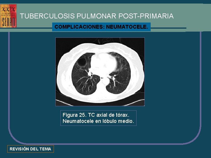 TUBERCULOSIS PULMONAR POST-PRIMARIA COMPLICACIONES: NEUMATOCELE. Figura 25. TC axial de tórax. Neumatocele en lóbulo