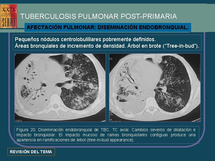 TUBERCULOSIS PULMONAR POST-PRIMARIA AFECTACIÓN PULMONAR: DISEMINACIÓN ENDOBRONQUIAL. Pequeños nódulos centrolobulillares pobremente definidos. Áreas bronquiales