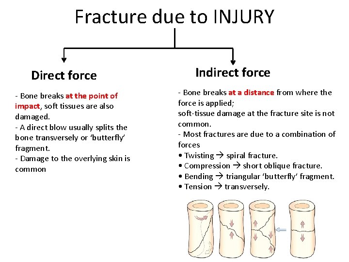 Fracture due to INJURY Direct force - Bone breaks at the point of impact,