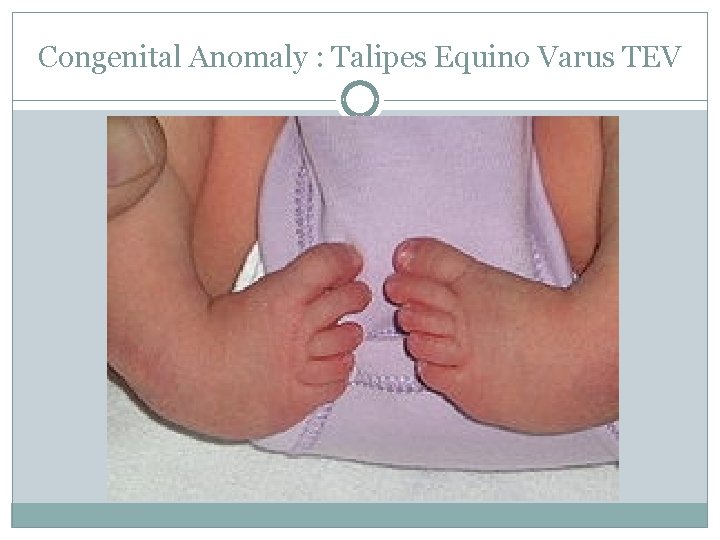 Congenital Anomaly : Talipes Equino Varus TEV 