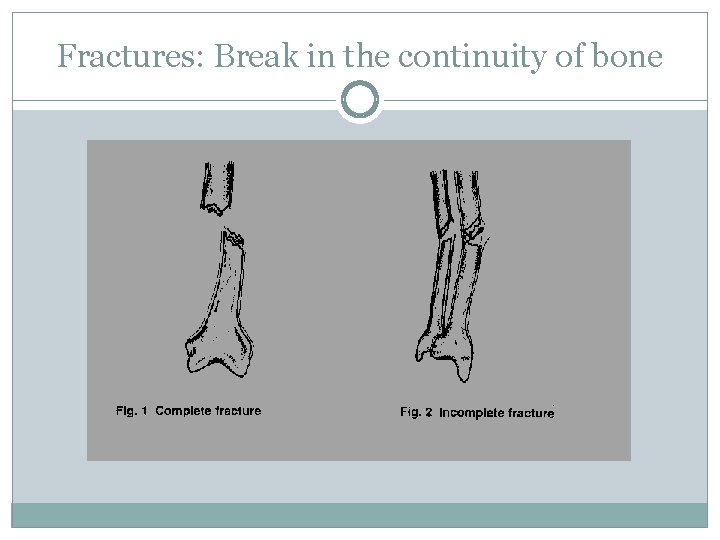 Fractures: Break in the continuity of bone 