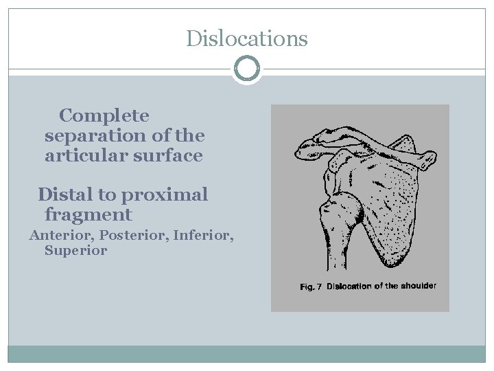 Dislocations Complete separation of the articular surface Distal to proximal fragment Anterior, Posterior, Inferior,