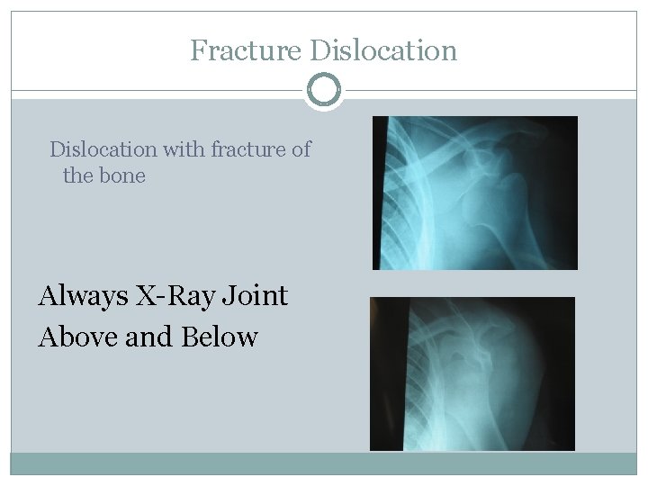 Fracture Dislocation with fracture of the bone Always X-Ray Joint Above and Below 