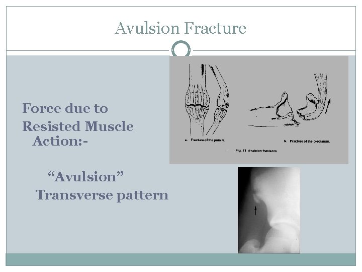 Avulsion Fracture Force due to Resisted Muscle Action: “Avulsion” Transverse pattern 