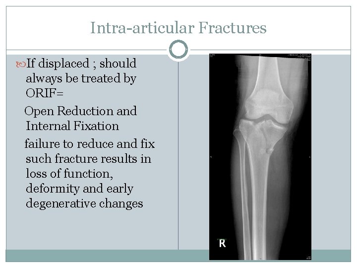 Intra-articular Fractures If displaced ; should always be treated by ORIF= Open Reduction and