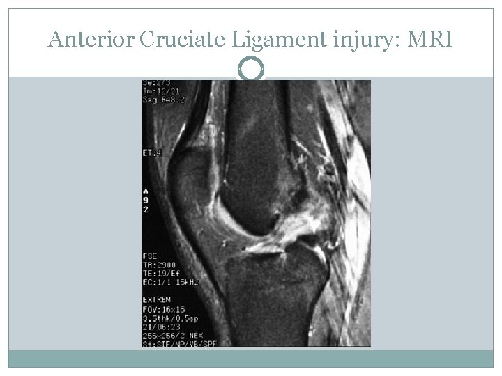 Anterior Cruciate Ligament injury: MRI 