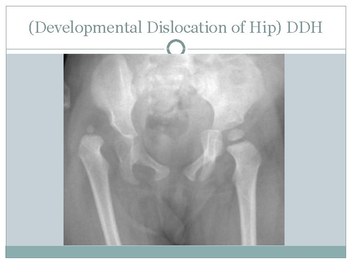 (Developmental Dislocation of Hip) DDH 