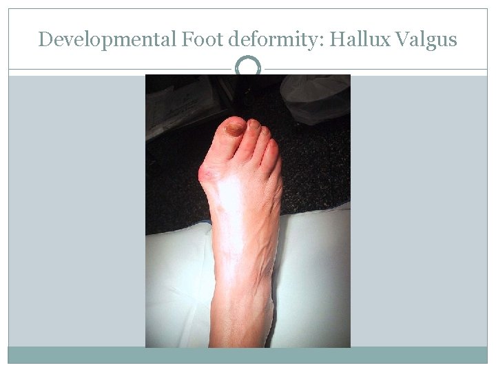 Developmental Foot deformity: Hallux Valgus 