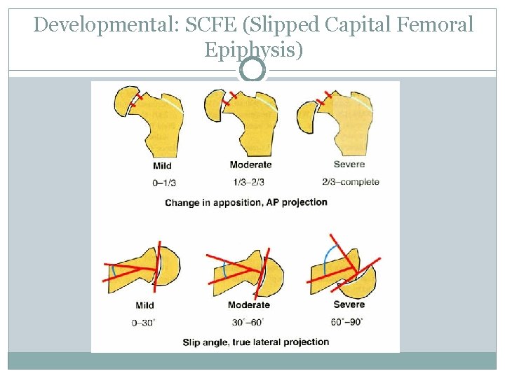 Developmental: SCFE (Slipped Capital Femoral Epiphysis) 