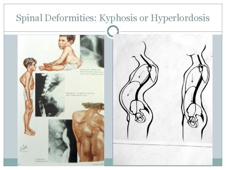 Spinal Deformities: Kyphosis or Hyperlordosis 