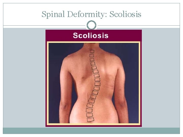 Spinal Deformity: Scoliosis 