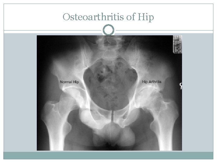 Osteoarthritis of Hip 