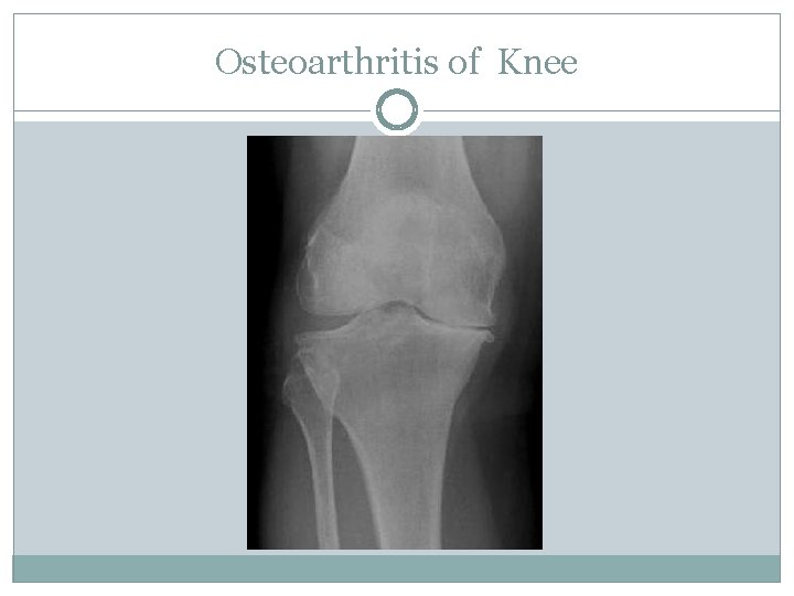 Osteoarthritis of Knee 