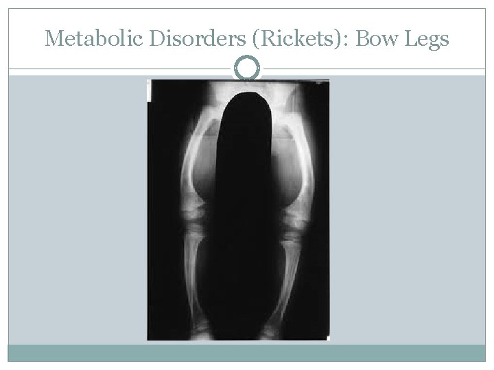 Metabolic Disorders (Rickets): Bow Legs 