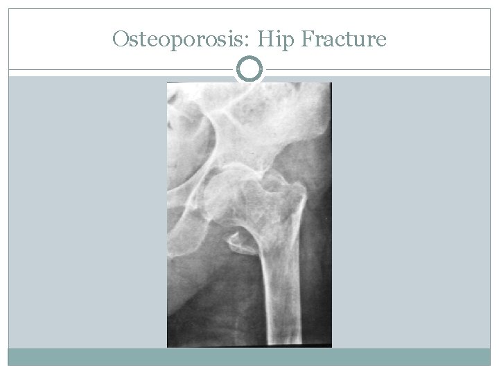 Osteoporosis: Hip Fracture 