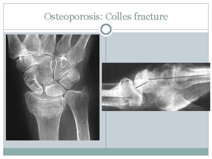 Osteoporosis: Colles fracture 