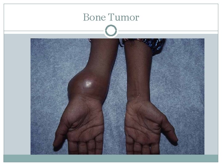 Bone Tumor 