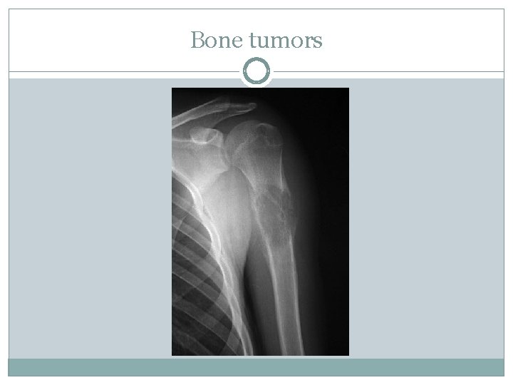 Bone tumors 