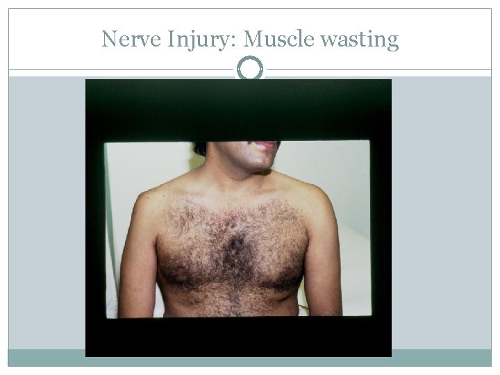 Nerve Injury: Muscle wasting 