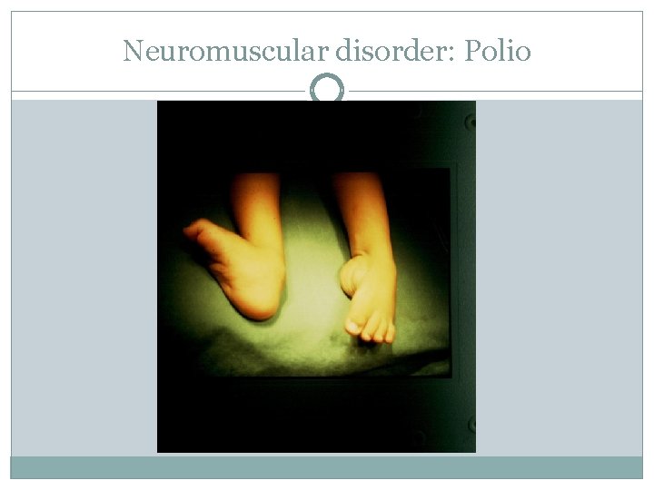 Neuromuscular disorder: Polio 