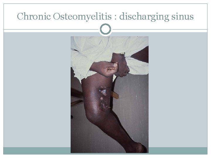 Chronic Osteomyelitis : discharging sinus 