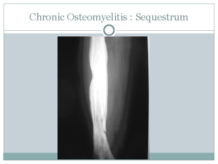 Chronic Osteomyelitis : Sequestrum 