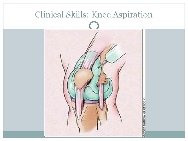 Clinical Skills: Knee Aspiration 