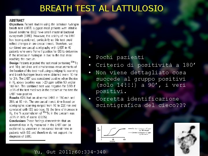 BREATH TEST AL LATTULOSIO • Pochi pazienti • Criterio di positività a 180’ •