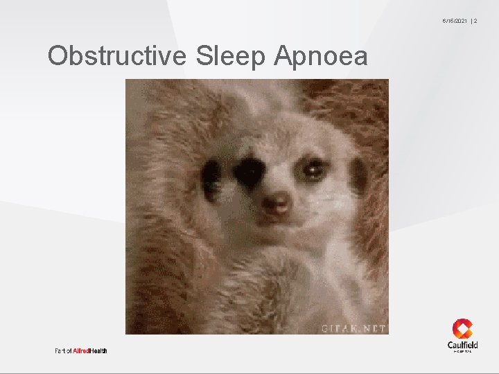 6/15/2021 Obstructive Sleep Apnoea 2 