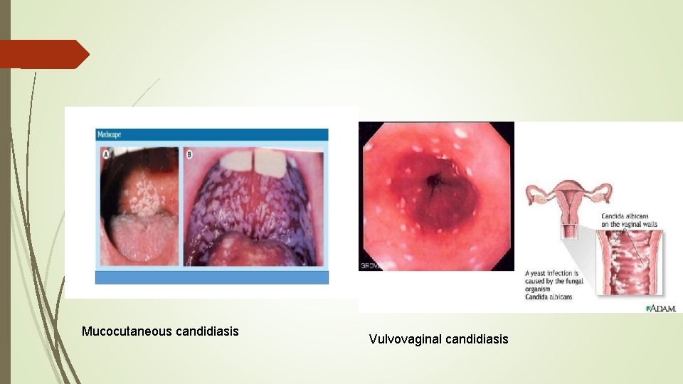 Mucocutaneous candidiasis Vulvovaginal candidiasis 