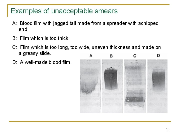 Examples of unacceptable smears A: Blood film with jagged tail made from a spreader