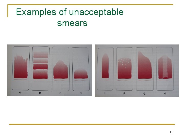 Examples of unacceptable smears 11 