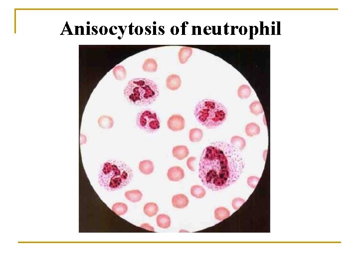 Anisocytosis of neutrophil 