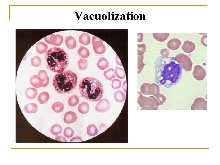 Vacuolization 