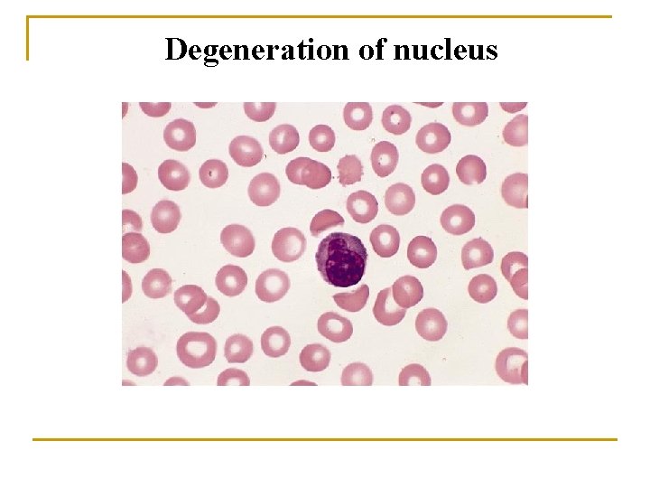 Degeneration of nucleus 