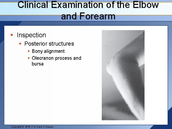 Clinical Examination of the Elbow and Forearm § Inspection § Posterior structures § Bony