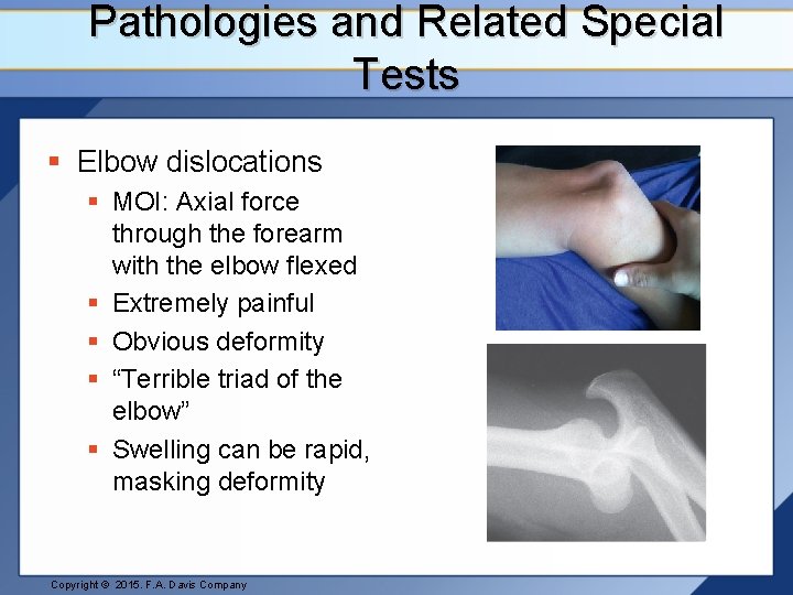 Pathologies and Related Special Tests § Elbow dislocations § MOI: Axial force through the